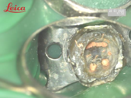 顯微根管案例分享B